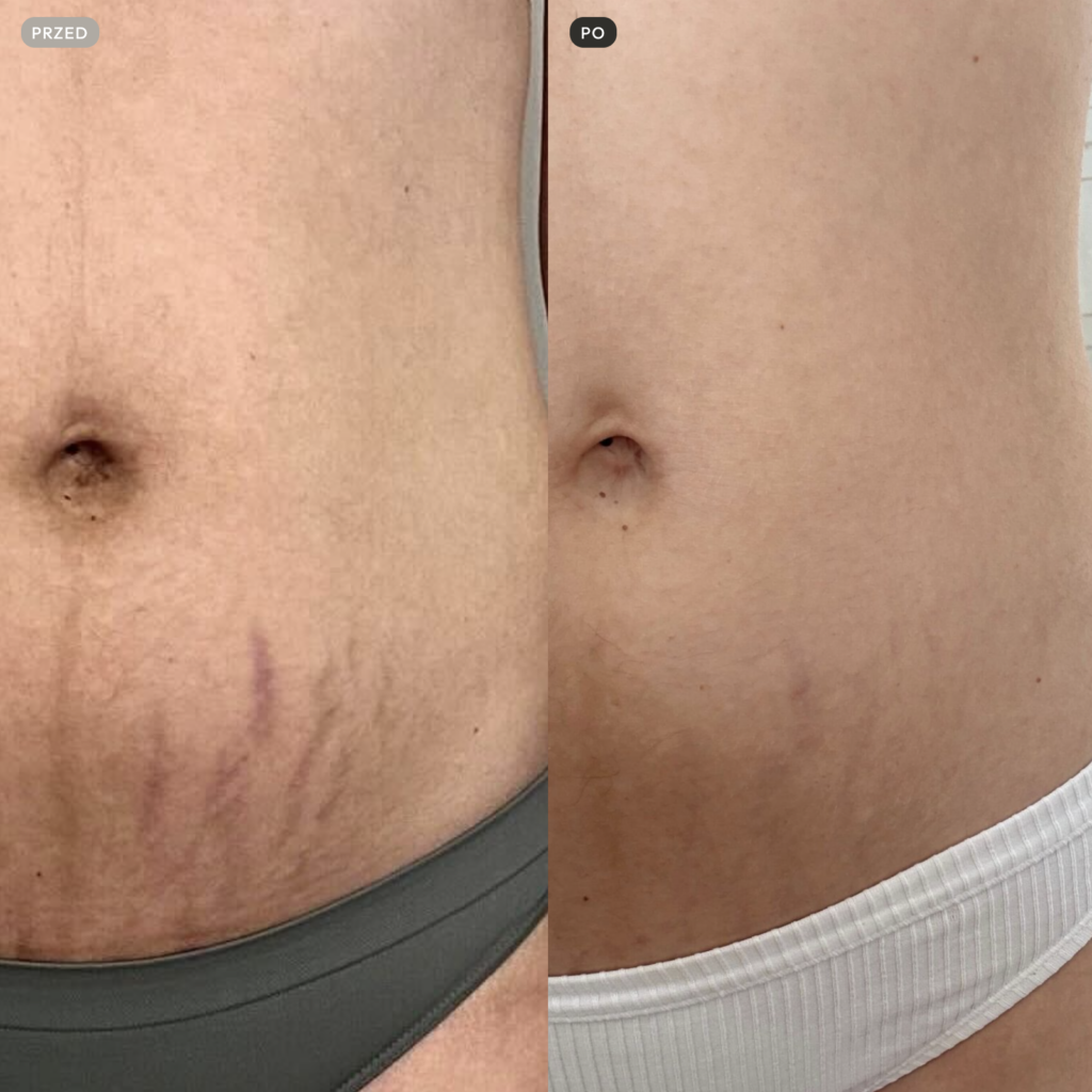 Stretch Marks Elixir